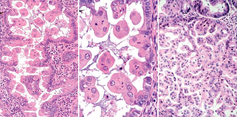 Fig. 8.27, Endometrioid adenocarcinomas with small nonvillous papillae. Left: Cellular buds composed of cells with eosinophilic cytoplasm line a gland and project into its lumen. Center: High-power view of tumor depicted in the left panel showing the cells in the papillae with copious eosinophilic cytoplasm. Right: There is an unusually florid intraglandular proliferation with luminal bridging.