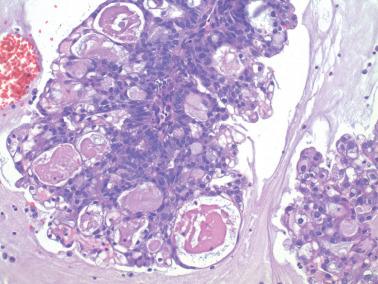 Fig. 8.28, Endometrioid adenocarcinoma with microglandular features. In isolation, the dilated glands are reminiscent of microglandular hyperplasia but lack the usual neutrophilic infiltrate and the smaller glands are inconsistent with microglandular hyperplasia.