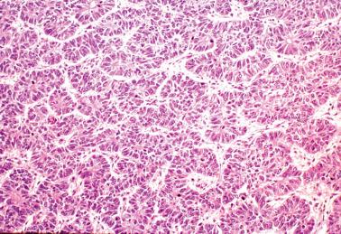 Fig. 8.29, Endometrioid adenocarcinoma with sertoliform pattern. Typical endometrioid carcinoma was present elsewhere in the specimen.