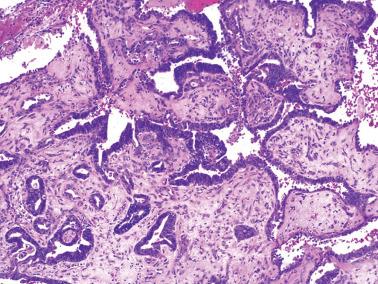 Fig. 8.30, Endometrioid adenocarcinoma, corded and hyalinized variant. Stromal hyalinization is conspicuous and cords are present to a limited degree.