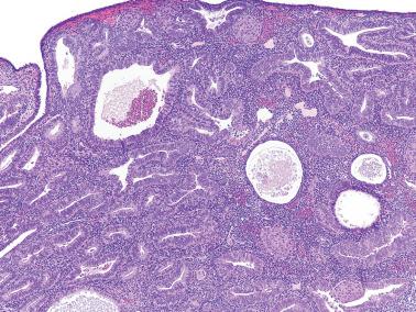 Fig. 8.3, Atypical hyperplasia. Glands with a moderately abnormal architectural arrangement contrast with several cystic atrophic glands. The cells lining the abnormal glands are stratified with cytologic atypia on higher power. A few squamous morules are also present.