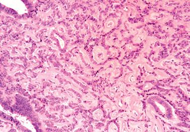 Fig. 8.31, Endometrioid adenocarcinoma with cords and hyalinized stroma.