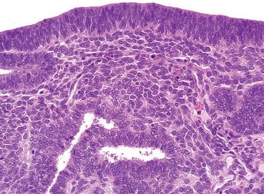 Fig. 8.34, Endometrioid adenocarcinoma, corded and hyalinized variant. A facet of this neoplasm is the presence of small fusiform cells between glands, which may mimic an endometrial stromal neoplasm.