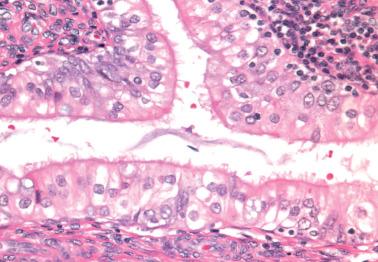 Fig. 8.36, Endometrioid adenocarcinoma with prominent ciliated cells.