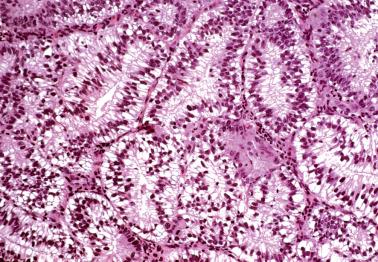 Fig. 8.37, Secretory variant of endometrioid adenocarcinoma. The glands are lined by cells with prominent subnuclear vacuoles.