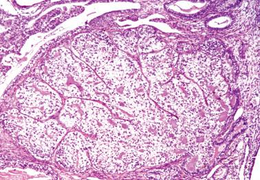 Fig. 8.38, Secretory variant of endometrioid adenocarcinoma, solid pattern. This appearance can be confused with clear cell carcinoma, but the illustrated focus was within an otherwise typical secretory carcinoma and had low-grade nuclear features like the rest of the tumor.