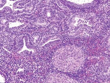 Fig. 8.4, Atypical hyperplasia. A higher-power view of the prior image demonstrates the cytologic atypia and a squamous morule.