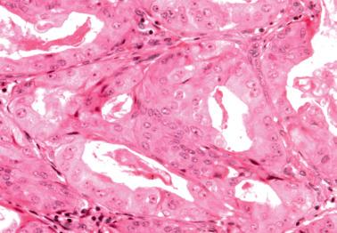 Fig. 8.41, Endometrioid adenocarcinoma composed of cells with abundant oxyphilic cytoplasm.