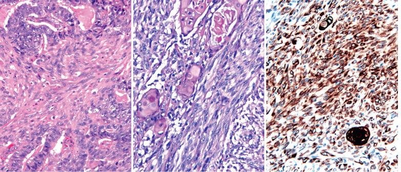 Fig. 8.42, Endometrioid adenocarcinoma with spindle cells (sarcomatoid carcinoma). Left: The spindle cells merge with the glandular cells. Center: The spindle cells surround and merge with nests with overt squamous differentiation (some with keratin). Right: The same tumor as in the center panel showing that the spindle cells are cytokeratin positive.