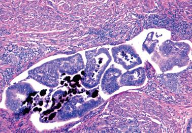 Fig. 8.43, Endometrioid adenocarcinoma within a lymphovascular space showing psammomatous calcification.