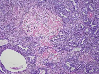 Fig. 8.44, Endometrioid adenocarcinoma with osseous metaplasia.