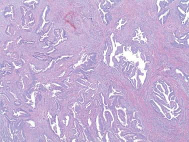 Fig. 8.45, Endometrioid adenocarcinoma with typical irregular infiltration of the myometrium. Note the stromal reaction.