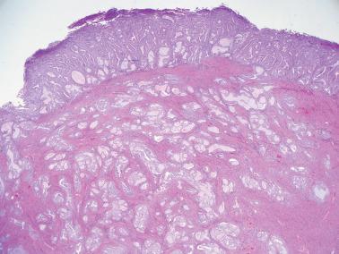 Fig. 8.46, Endometrioid adenocarcinoma. There is extensive myometrial invasion. Note the lack of an appreciable stromal response.