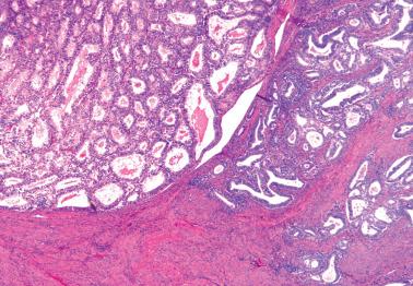 Fig. 8.47, Myoinvasive endometrioid adenocarcinoma with pushing (left) and infiltrative (right) patterns.