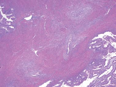 Fig. 8.48, Endometrioid adenocarcinoma with MELF pattern of invasion. Foci of invasive carcinoma are highlighted by a stromal reaction, and some of the neoplastic glands are elongated.