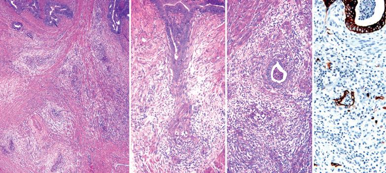 Fig. 8.49, Endometrioid adenocarcinoma invading myometrium, ‘MELF’ pattern (see text). Extreme left: Typical endometrioid carcinoma (top) merges with deeper myoinvasive foci exhibiting a prominent fibromyxoid stromal response. Left center: A neoplastic endometrioid gland (top) merges with a focus of tumor (bottom) that is obscured by an inflamed myxoid stroma. Right center: An inflamed fibromyxoid stroma surrounds a typical endometrioid gland and fragments of glandular epithelium (lower half of field) that are barely visible at this magnification. Extreme right: The fragments of glandular epithelium depicted in the right center panel are highlighted with a cytokeratin stain.