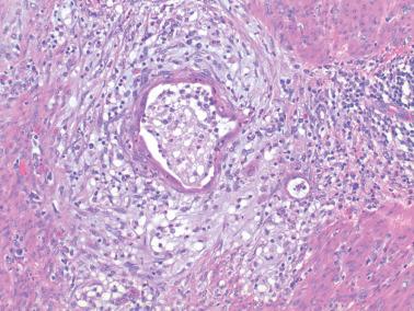 Fig. 8.50, Endometrioid adenocarcinoma with MELF pattern of invasion. Two typical microcystic glands, one much larger than the other, are associated with a prominent myxoid stroma. Note the flattening of the epithelium lining the glands.