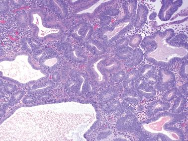 Fig. 8.5, Atypical hyperplasia. There is moderate glandular complexity and focal cytologic atypia.