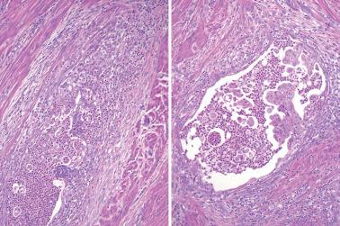 Fig. 8.51, Endometrioid adenocarcinoma with MELF pattern of invasion. The typical fragmentation of the neoplastic epithelium which is sometimes associated with a neutrophilic infiltrate is seen in both examples. The right also demonstrates the eosinophilic cytoplasmic changes and attenuated flattened epithelium which are frequently seen in such cases.