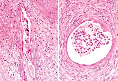 Fig. 8.52, Endometrioid adenocarcinoma invading myometrium, ‘MELF’ pattern. An elongated slit-like gland (left) and a round gland (right) are surrounded by a fibromyxoid stroma. The glands are mostly lined by flattened eosinophilic cells that could be mistaken for endothelial cells lining lymphovascular spaces.