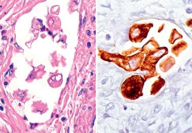 Fig. 8.53, Endometrioid adenocarcinoma, lymphovascular invasion, histiocyte-like cells (left: H&E; right: cytokeratin).