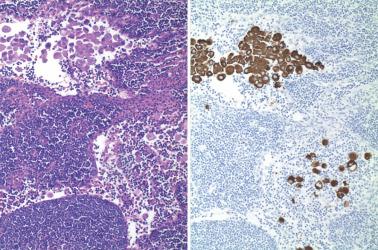 Fig. 8.54, Endometrioid adenocarcinoma involving a lymph node. Left: The neoplastic cells have abundant eosinophilic cytoplasm, which can be mistaken for histiocytes. This picture is more frequently seen in cases having a MELF pattern of myometrial invasion. Right: Cytokeratin AE1/AE3 staining can be useful to distinguish the neoplastic cells from histiocytes.