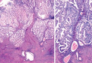 Fig. 8.56, Endometrioid adenocarcinoma confined to the endometrium with an irregular endometrial-myometrial junction. The higher-power view (right) shows residual benign glands between the tumor and the myometrium.