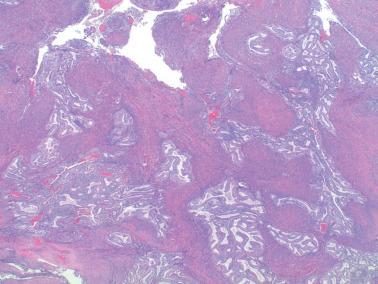 Fig. 8.57, Endometrioid adenocarcinoma with involvement of adenomyosis. The expanded foci of involved adenomyosis are somewhat evenly arranged without an associated stromal reaction. Additionally, darkly staining foci surrounding the periphery of the adenomyotic foci represent a cuff of endometrial stromal cells, a helpful finding.