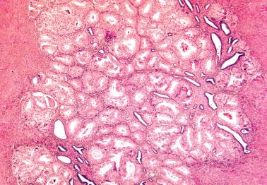 Fig. 8.58, Endometrioid adenocarcinoma involving adenomyosis. Benign adenomyotic glands, some surrounded by adenomyotic stroma, are admixed with the neoplastic glands.