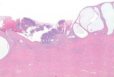 Fig. 8.59, Endometrioid adenocarcinoma involving the endocervical surface without stromal invasion