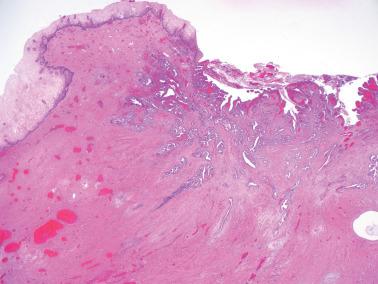 Fig. 8.60, Endometrioid adenocarcinoma with cervical stromal invasion.