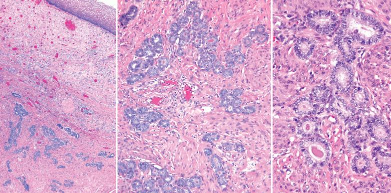 Fig. 8.61, Endometrioid adenocarcinoma with a deceptive pattern of cervical stromal invasion. Left and center: Although the tumor in the corpus was a typical endometrioid carcinoma, the tumor invading the cervix consists of lobular clusters of small tubular glands without a desmoplastic stroma, an appearance resembling that of mesonephric hyperplasia. Right: The tubular glands are lined by only mildly atypical cells. Some of the lumina contain an eosinophilic colloid-like secretion.