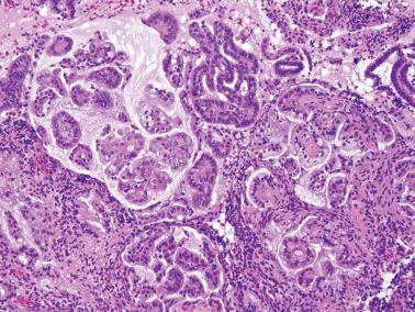 Fig. 8.62, Endometrioid adenocarcinoma, FIGO grade 1, post progestin therapy. Several features common in this setting are seen, including papillae, mucinous metaplasia, and bland cytologic features.