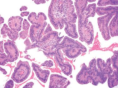 Fig. 8.63, Endometrioid adenocarcinoma, FIGO grade 1, post progestin therapy. A prominent papillary pattern with low-grade cytologic features is seen. The neoplastic cells have abundant eosinophilic cytoplasm, another occasional feature of treatment associated cases.