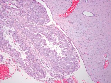 Fig. 8.64, Endometrioid adenocarcinoma, FIGO grade 1, post progestin therapy. In the absence of an appropriate history, it would be difficult to make a certain diagnosis of carcinoma given the differentiated nature of the epithelium, although a focal cribriform pattern is seen. Note the abundant decidual stromal change on the right, which in the absence of a good clinical history would impact the interpretation.