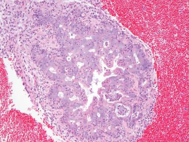 Fig. 8.65, Endometrioid adenocarcinoma, FIGO grade 1, post progestin therapy. A higher power view of glands in the previous illustration showing innocuous cytologic features as often seen post progestin therapy.