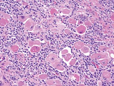 Fig. 8.66, Endometrioid adenocarcinoma post radiation therapy. In some such cases only residual foci of relatively mature squamous cells with conspicuous keratin are seen.