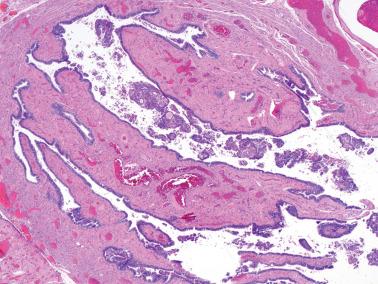 Fig. 8.67, Artifactual displacement of endometrioid carcinoma into the tubal lumen.