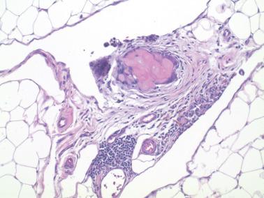 Fig. 8.68, Peritoneal keratin granuloma. The surface of the omentum contains a small aggregate of ‘ghost’ squamous cells surrounded by giant cells. Viable tumor cells are not seen.