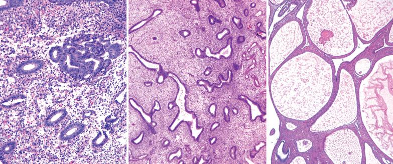 Fig. 8.7, Potential mimics of endometrial hyperplasia. Left: Normal proliferative endometrium with single highly coiled gland. Center: Disordered proliferative endometrium. Right: Cystic atrophy. In contrast to hyperplasia with cystic glands, the glands are lined by flattened cells and are separated by a fibrous stroma.