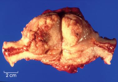 Fig. 8.8, Gross appearance of an endometrial carcinoma of endometrioid type. A polypoid mass fills the endometrial cavity.