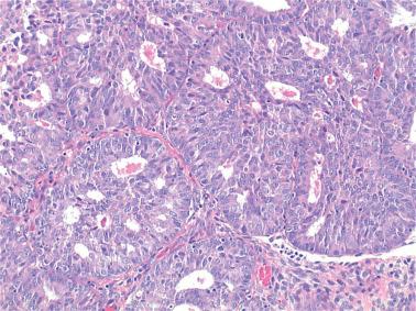 Fig. 8.9, Endometrioid adenocarcinoma, FIGO grade 1. Typical tubular glands in a cribriform pattern are seen.