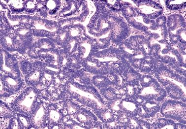 Fig. 8.10, Endometrioid adenocarcinoma, FIGO grade 1. The glands have coalesced to form a confluent growth.