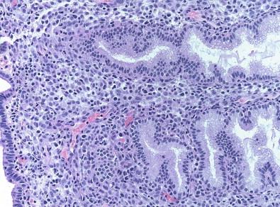 Figure 10-2, Late secretory phase endometrium. Endometrial biopsy, histologic section (H&E, ×HP). Note the extensive stromal decidual reaction and tortuous glands containing luminal secretions.