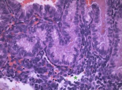 Figure 10-3, Menstrual phase endometrium. Endometrial biopsy, histologic section (H&E, ×HP). Note the collapsing stroma (asterisk), and exhausted secretory-type glands with degenerative vacuoles and apoptosis.