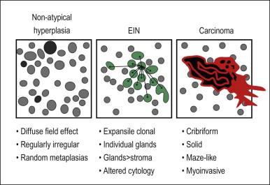 Figure 17.1, General features that distinguish EIN from non-atypical hyperplasia and carcinoma. (For carcinoma, see also Figure 18.12 .)