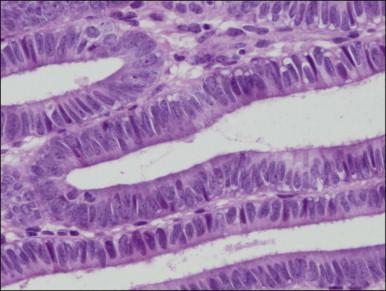 Figure 17.12, Non-atypical hyperplasia, detail of inactive phase. Amitotic epithelium, indicating that high estrogen levels are no longer present.