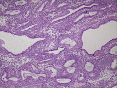 Figure 17.13, Delayed ovulation following protracted estrogen stimulation superimposes secretory change upon pre-existing cystic architecture.