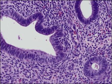 Figure 17.4, Cytology of disordered proliferative glands resembles that of normal proliferative endometrium, surrounded by a dense stroma.