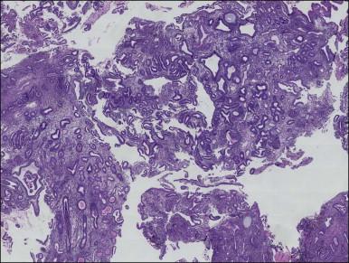 Figure 17.6, Macroscopic view of non-atypical hyperplasia showing randomly distributed cysts and variable gland spacing across multiple fragments. This presents a ‘regularly irregular’ pattern, in which there is a broad symmetry among fragments at very low magnification, which disappears at smaller scales where each field looks different.